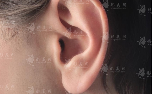 玻尿酸豐耳垂:安全性與栓塞風(fēng)險(xiǎn)探討 玻尿酸豐耳垂:安全性與栓塞風(fēng)險(xiǎn)探討