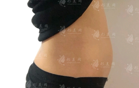 腰腹環(huán)吸會(huì)影響月經(jīng)嗎？及注意事項(xiàng)