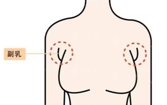 副乳是否必須要切掉去除？