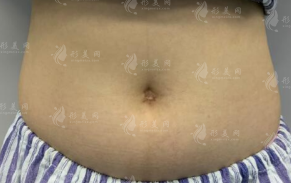 大肚子抽脂有用嗎？效果取決于哪些因素？