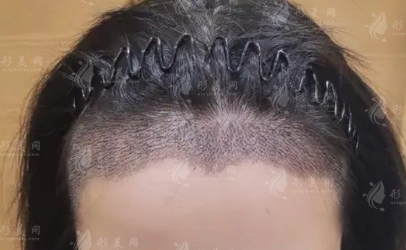 發(fā)際線種植的特點(diǎn)：重塑美麗，自然持久