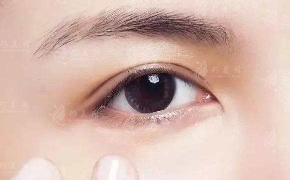 如何去除淚溝:醫(yī)美方法詳解 如何去除淚溝:醫(yī)美方法詳解