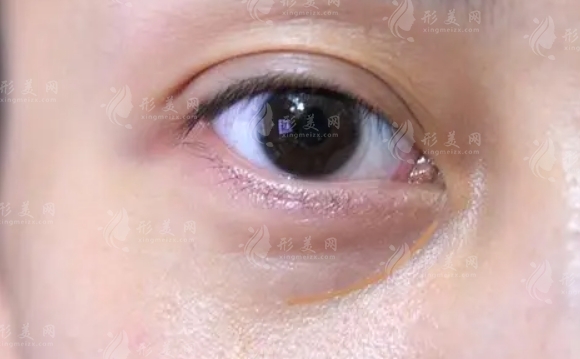 如何撫平淚溝有效？膠原蛋白填充淚溝的優(yōu)點