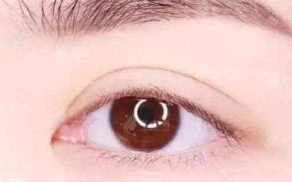 雙眼皮修復(fù)成功率高嗎？什么人適合做？