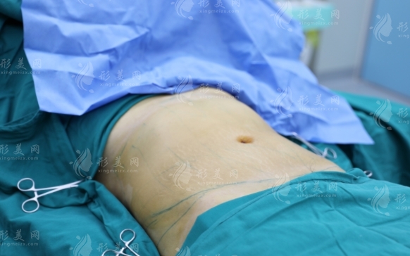 抽脂術(shù)后會(huì)復(fù)胖嗎？分享抽脂術(shù)后正確觀念