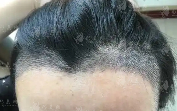 植發(fā)一次要取多少毛囊？微針植發(fā)技術(shù)詳解