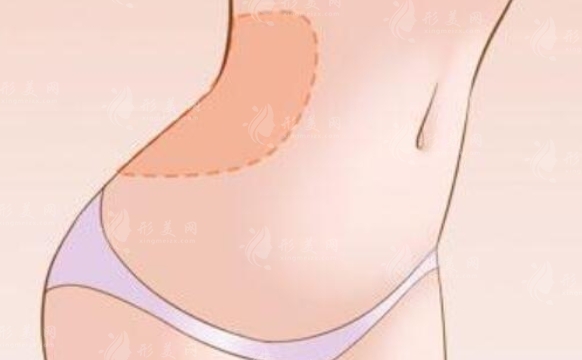 腰腹環(huán)吸抽脂：恢復期與后遺癥解析