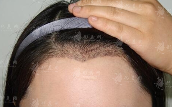 種植美人尖：價格與術后注意事項
