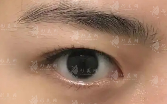腫眼泡割雙眼皮：能否改良與術后恢復時間