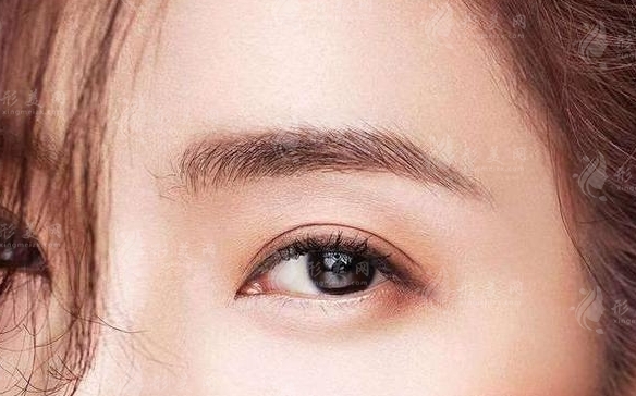 眉弓脂肪填充后眼睛腫脹多久？7天能否恢復？