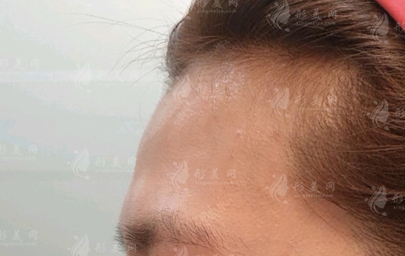 填充額頭：選擇何種方法比較？?jī)煞N優(yōu)質(zhì)材料解析