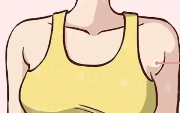 副乳手術(shù)費用及真假副乳辨析