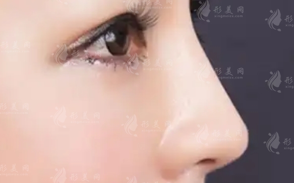 鼻尖縮小手術(shù):效果與恢復(fù)指南 鼻尖縮小手術(shù):效果與恢復(fù)指南
