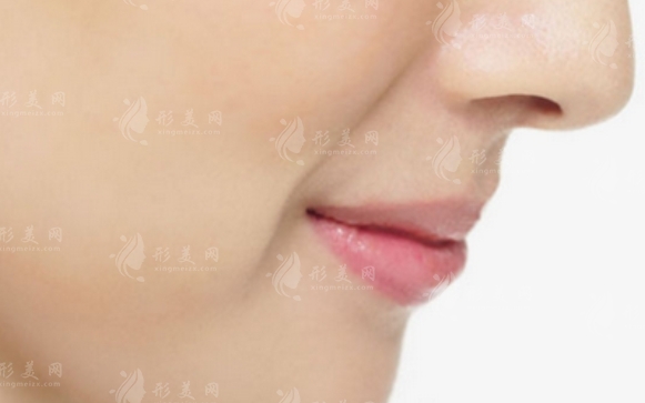鼻唇溝微整形費(fèi)用及其影響因素 鼻唇溝微整形費(fèi)用及其影響因素