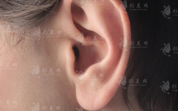 自體脂肪豐耳垂的缺陷及彌補(bǔ)方法 自體脂肪豐耳垂的缺陷及彌補(bǔ)方法