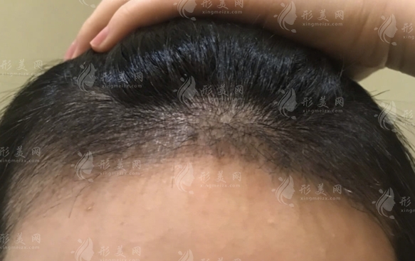 哪些因素影響自體毛發(fā)移植價格？