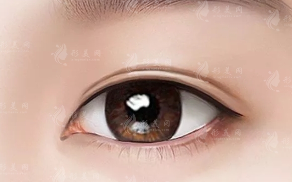 切開(kāi)法重瞼術(shù):適用人群與長(zhǎng)期效果解析