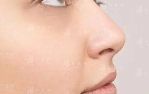 墊鼻頭的優(yōu)缺點(diǎn)：一次全面的探索