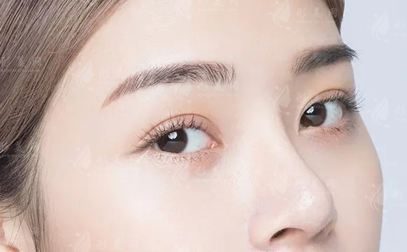 無痕隆鼻：追求自然美觀的微創(chuàng)選擇