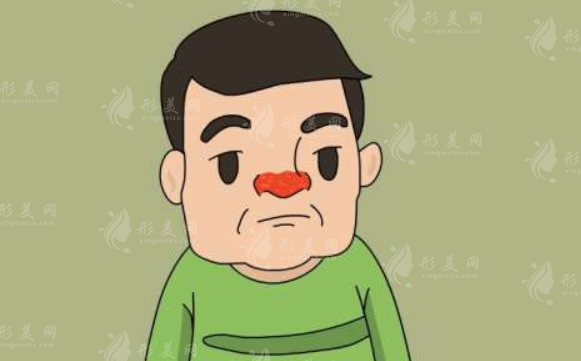 酒糟鼻術后會復發(fā)嗎？應對策略有哪些？