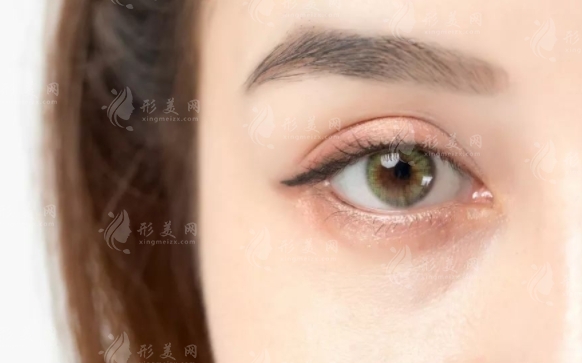 玻尿酸填充眼窩多久可以恢復自然？