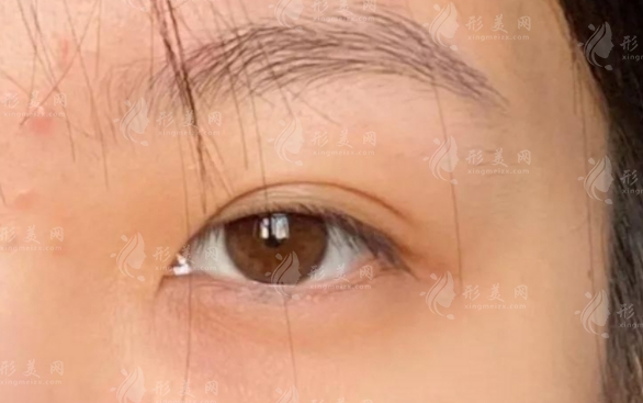 無痕開內(nèi)眼角手術(shù)流程一覽
