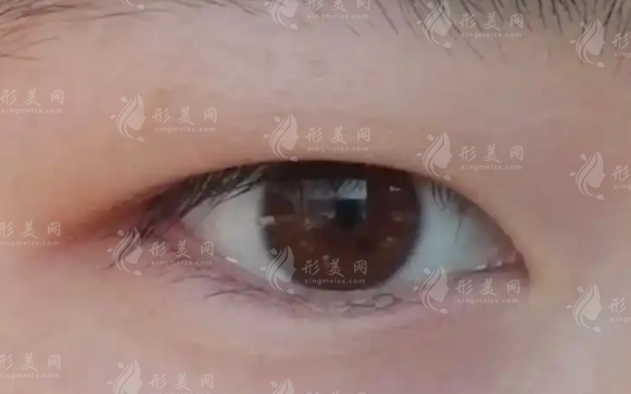 腫眼泡能否只抽脂不割雙眼皮？