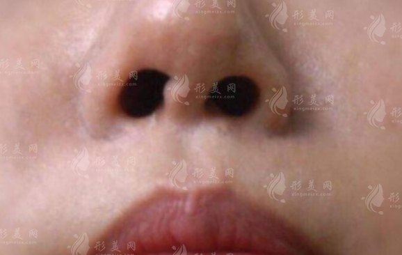 鼻孔縮小手術(shù)方法及其特點(diǎn) 鼻孔縮小手術(shù)方法及其特點(diǎn)