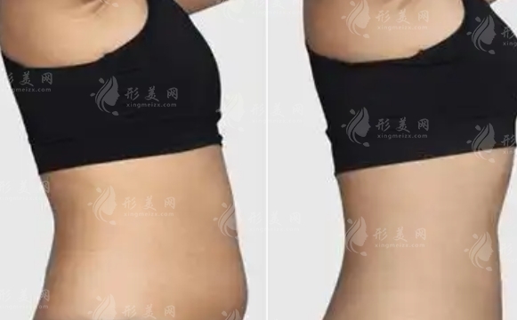 產(chǎn)后多久做吸脂減肥手術(shù)比較好？產(chǎn)后吸脂手術(shù)的禁忌癥一覽