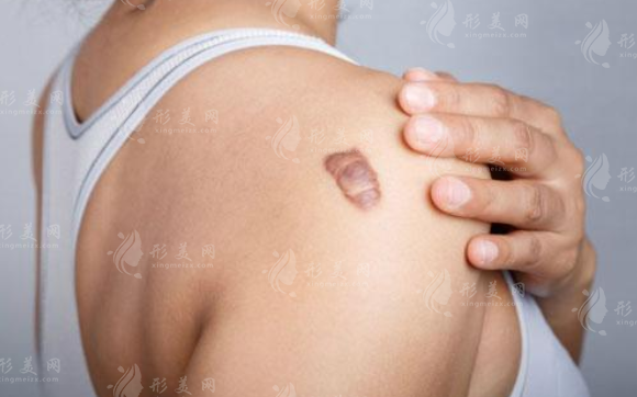 激光疤痕修復(fù)：價(jià)格與術(shù)后注意事項(xiàng)解析