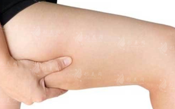 大腿吸脂后出現(xiàn)肉條怎么辦？應(yīng)該怎么避免？