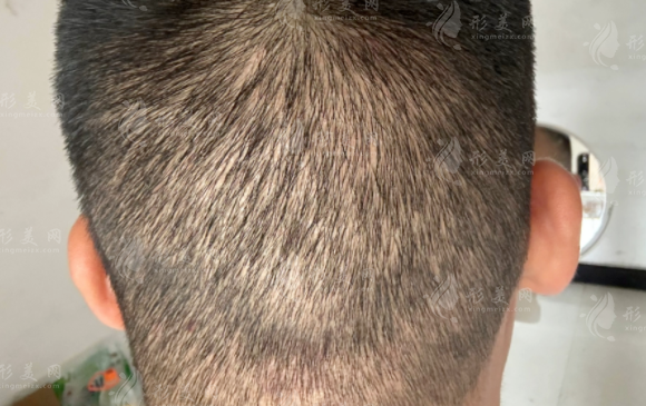 植發(fā)加密多少錢一個單位？會損傷原有頭發(fā)嗎？