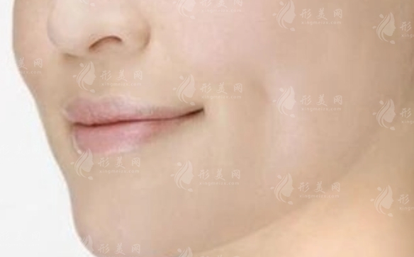 人造酒窩能保持多久？與天生酒窩相比有何區(qū)別？