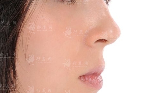 膨體隆鼻：能否一輩子不取出來？全新優(yōu)缺點(diǎn)展示