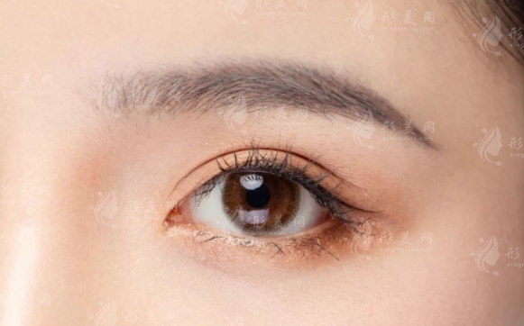 輕度內(nèi)眥贅皮的矯正方法