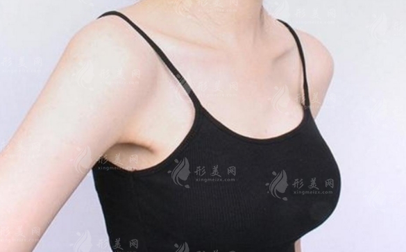 假體隆胸手術(shù)失敗修復(fù)難度高嗎？恢復(fù)時(shí)間長(zhǎng)不長(zhǎng)？