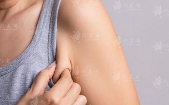 副乳切除術(shù)的切口位置選擇 副乳切除術(shù)的切口位置選擇