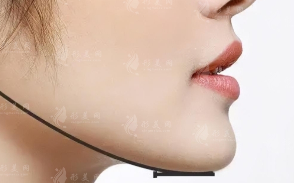 下頜角手術費用及術后注意事項 下頜角手術費用及術后注意事項