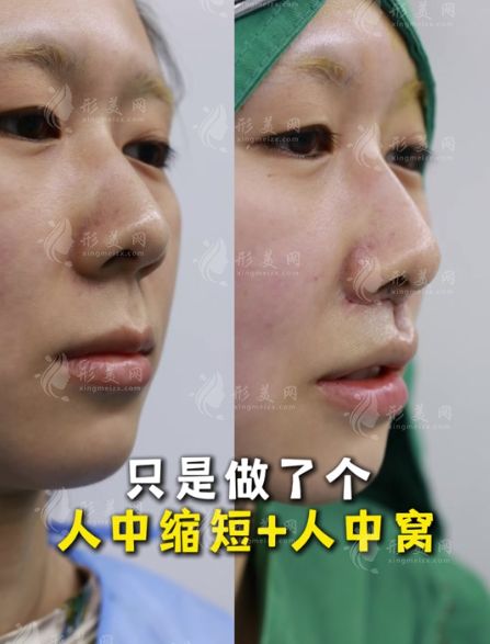 人中縮短術(shù)對比照片:明星都在悄悄做的減齡秘訣 人中縮短術(shù)對比照片:明星都在悄悄做的減齡秘訣