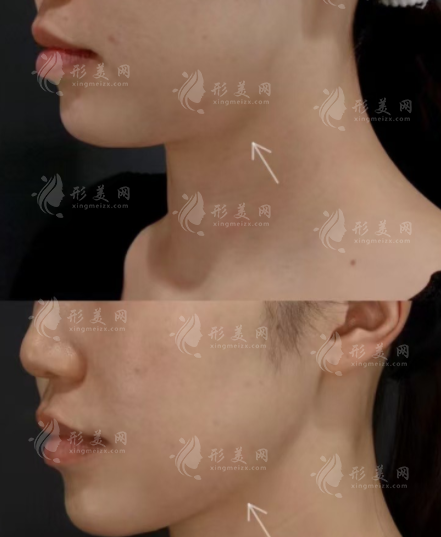 上海時光做下頜角靠譜嗎?技術(shù)價格醫(yī)生全解析 上海時光做下頜角靠譜嗎?技術(shù)價格醫(yī)生全解析