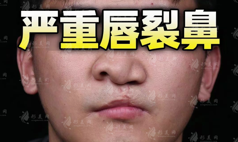 唇裂術(shù)后鼻孔不對稱怎么辦？鼻畸形修復(fù)術(shù)全攻略