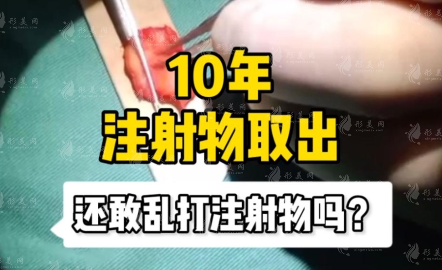 張本軍醫(yī)生取異物技術(shù)好嗎？上海整形價格費用全揭秘