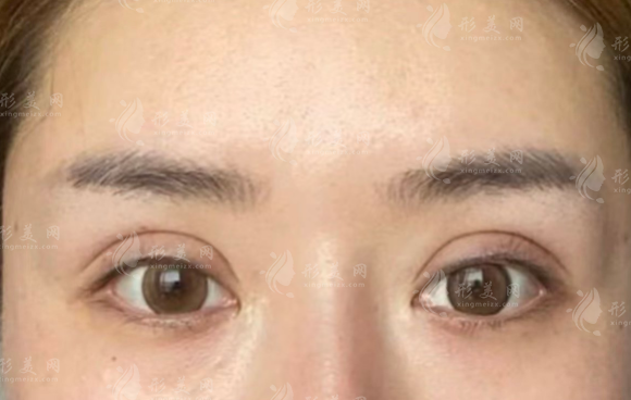 北京張冰潔眼修復(fù)技術(shù)可靠嗎?媽生感效果實(shí)測(cè) 北京張冰潔眼修復(fù)技術(shù)可靠嗎?媽生感效果實(shí)測(cè)
