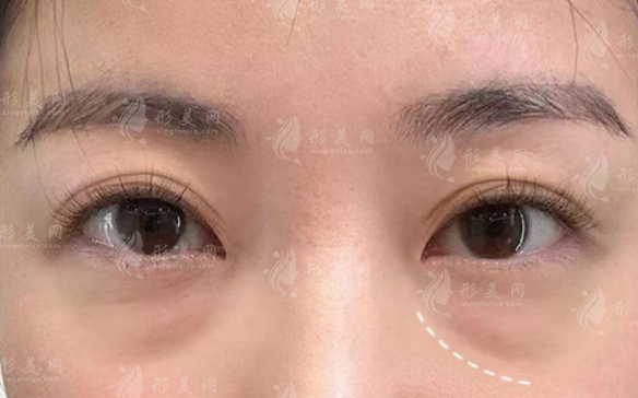 去眼袋580元靠譜嗎?低價眼袋手術真相揭秘 去眼袋580元靠譜嗎?低價眼袋手術真相揭秘
