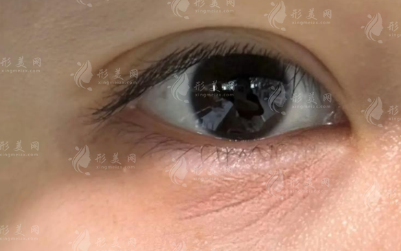 眼周注射膠原蛋白去細(xì)紋靠譜嗎？效果真相大揭秘