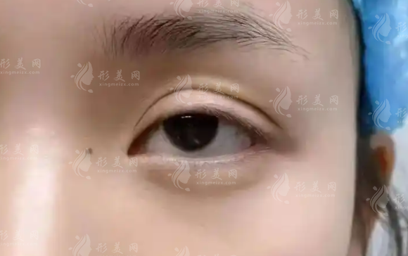 北京張冰潔眼修復(fù)口碑怎么樣?20年經(jīng)驗(yàn)+解剖復(fù)位技術(shù)解析 北京張冰潔眼修復(fù)口碑怎么樣?20年經(jīng)驗(yàn)+解剖復(fù)位技術(shù)解析