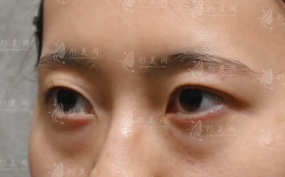 580元改善眼袋靠譜嗎?揭秘低價去眼袋的隱藏真相