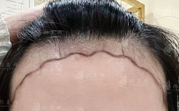 天津植發(fā)醫(yī)院哪家好?熙朵植發(fā)上榜前三技術(shù)價格全解析 天津植發(fā)醫(yī)院哪家好?熙朵植發(fā)上榜前三技術(shù)價格全解析