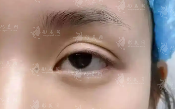 鄭小紅眼修復(fù)1.3萬起貴嗎?看完技術(shù)細(xì)節(jié)再判斷! 鄭小紅眼修復(fù)1.3萬起貴嗎?看完技術(shù)細(xì)節(jié)再判斷!