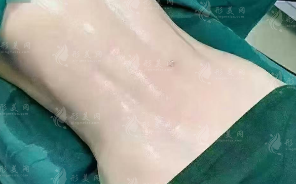 寧波吸脂醫(yī)院哪家好？排名前三正規(guī)醫(yī)院名單揭曉